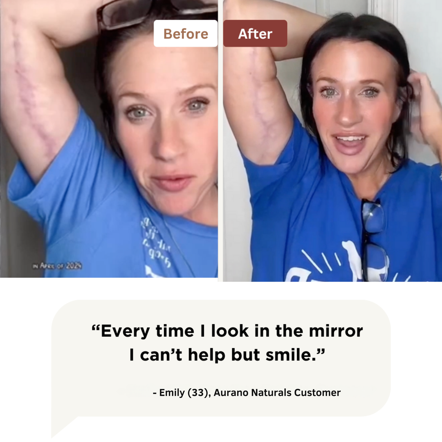 Aurano Naturals Silicone Scar Stick ™